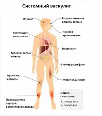 Узелковый периартериит может вызывать сильные боли в животе и лихорадку. Uzelkovyj Poliarteriit U Detej