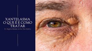 Image result for xantelasma