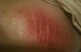 Inner thigh chafing is a common skin irritation that can happen when your inner thighs rub against each other. How To Prevent Chafing In 2021 Best Tips And Remedies To Heal Fast Greenbelly Meals