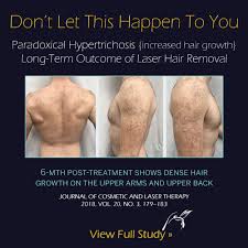 Instead of hair removal, tweezing and plucking facial hair is done more for maintenance reasons, but not without pros and cons. Paradoxical Hypertrichosis Beware Of Laser Hair Removal