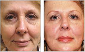 Ablative Laser Treatments