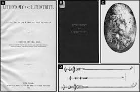 Yes fascia is very tough i don't see how you would get it torn with pe. Beyond Buck S Fascia The Life And Contributions Of Dr Gurdon Buck 1807 1877 Urology