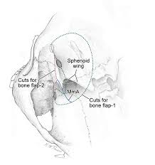 Type 1 diabetes happens when your immune system destroys cells in your pancreas that make insulin. Cureus Two Part Pterional Craniotomy