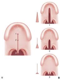 Operarán gratis a liberteños con labio fisurado y paladar hendido. Tratamiento Primario Del Labio Leporino Y Del Paladar Hendido Sciencedirect