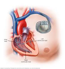 Metal detectors can be used for all kinds of utilitarian purposes in addition to their hobby and sporting uses. Pacemaker Mayo Clinic