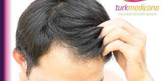 علاج الشعر الخفيف من الأمام turkmedicana