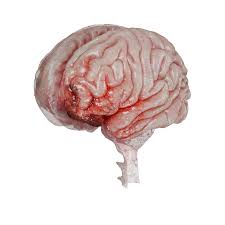Image result for Brain Contusion