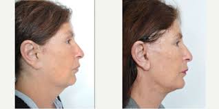 Benjamin C. Paul, MD, Board Certified Facial Plastic Surgeon