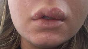Check spelling or type a new query. Jangan Diabaikan 7 Tanda Di Bibir Ini Menandakan Kesehatan Anda Bermasalah Citizen6 Liputan6 Com
