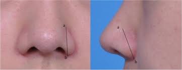 In view of retrospective nature with the participants involved remained anonymous, the consent was not required by the ethics committee. The Arrow Tip Technique For Bilateral Hanging Ala A 3 Year Review Springerlink