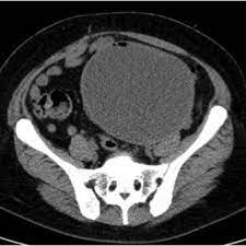 Learn about the symptoms, causes, and how to manage it. A Rare And Acute Presentation Of Endometriosis Eurorad