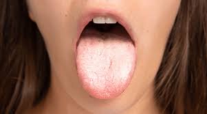 Image result for Candidiasis