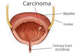Bladder cancer does not necessarily cause urinary tract infections (uti), but the symptoms and signs may be mistaken for a uti. Bladder Cancer Early Diagnosis Improves Prognosis