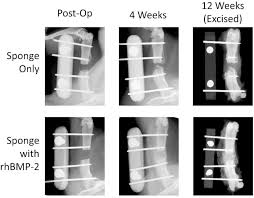 Bertrand boyer chu de st etienne 19 novembre 2014. A Reliable And Reproducible Critical Sized Segmental Femoral Defect Model In Rats Stabilized With A Custom External Fixator Protocol