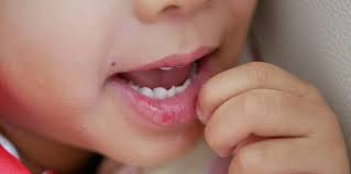 Punca sebenar ekzema sehingga kini masih menjadi tanda tanya. 7 Cara Mengatasi Bibir Pecah Pecah Pada Balita