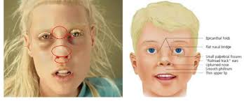 The asian face has unique characteristics including small eyes, which is accentuated by the presence of single eyelid, medial epicanthal fold and a broad flat nasal dorsum. Yolandi Vs Fas Dieantwoord