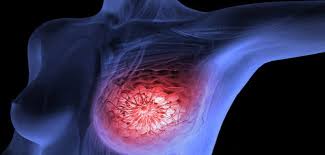 Breast screening is a safe and helpful way to detect breast cancer early, especially in women aged 50 to 74. 10 Signs And Symptoms Of Breast Cancer Extrachai