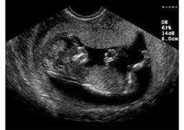 كيف يكون شكل الجنين في الشهر الثالث من الحمل