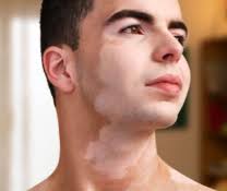 Image result for Vitiligo