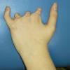He was the first mainstream presenter with a visible disability, an unusually small right hand due to poland syndrome. 1