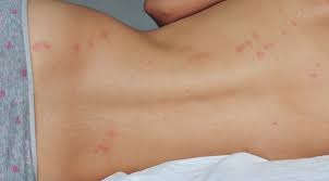 If you think that your home smells like cat's urine, or your furniture is. What To Know About Bed Bug Bites Bed Bug Guide