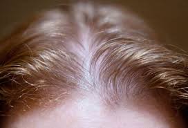 What to expect during an. Women S Hair Loss Causes Treatments And Solutions