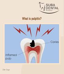 Image result for Pulpitis