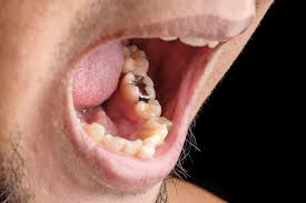 Nach entfernung kariös zerstörter zähne liegt im kieferknochen in a) wurzelentzündungen toter zähne. Diese Krankheiten Werden Durch Kranke Zahne Verursacht Gelencser Dental Magazin