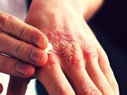 Scabies is a skin condition caused by microscopic mites called sarcoptes scabei. Rs Meilia Scabies Kudis