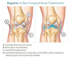 They're often caused by ligament damage. Knee Pain Doctors Nyc Knee Injury Treatment In Manhattan