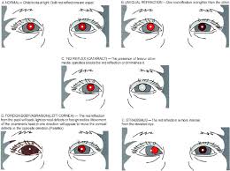 Learn more about our vision care plan today. Pediatric Eye Evaluations Preferred Practice Pattern Ophthalmology