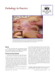 Other more obvious signs will include difficulty or straining in urination, blood in the urine, or noticeable swelling of the region overall. Pdf Pathology In Practice Sertoli Cell Tumor Sct