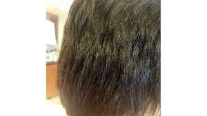 Many hair dyes contain chemicals that can cause your scalp to react and feel itchy, especially when the hair dye is sitting on your scalp for an extended period of time. Scabs And Sores On Scalp Treatment Causes And Remedies