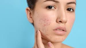 Your Search For the Best Acne Treatments in Dallas Stops Here
