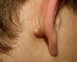 Most of these cancers start in the skin of the outer ear. Natural Remedies For Lump Behind Ear Its Causes And Symptoms Ultima Status
