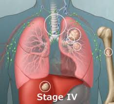 Some symptoms of high calcium levels include frequent urination, excessive thirst, constipation, nausea, belly pain. Lung Cancer Lung Health A Z Chest Foundation