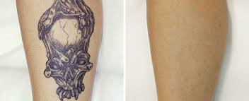 Today, laser tattoo removal is the most popular way to remove a tattoo. Tattoo Removal Fotona