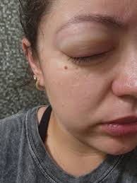 Hello! I had an erg done 3 days ago, the one where they put a little wire  in your eyes, without the contacts. I'm still waiting to hear from my  retinal specialist.