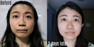 After hiruscar post acne treatment. Ireviewuread