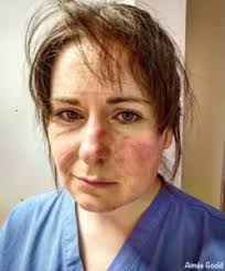 Aimee Goold ICU Nurse Selfie Self Portrait PPE Bruises