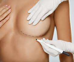 Breast implants add volume to existing breast tissue to create a fuller chest. Breast Implant Revision London Uk The Hamlet Clinic