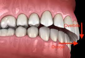 A minor overbite may not cause any noticeable health issues. How To Fix An Overbite Causes And Corrections Bdg