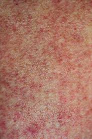 Lättare hud och ögon på grund av onormala nivåer av melanin. Varmeutslag Barn Varmeutslag Vuxen Hudsjukdomar Se