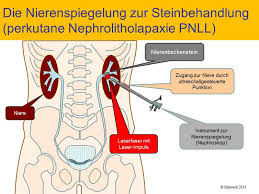 Klinikum Ingolstadt Gmbh Nierensteinpunktion Perkutane Nephrolitholapaxie