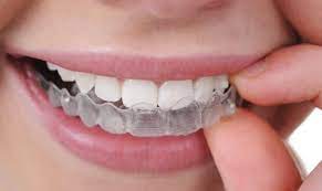 That's because teenager's teeth are easier to move and more responsive to treatment. How Long Do Invisalign Aligners Take To Work Invisalign