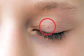 Sùi mào gà ở mắt giai đoạn đầu có chữa được không?