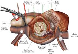The mitral valve was named for a fancied resemblance to a bishop's mitre. Mitral Annular Calcification And Mitral Valve Replacement A New Approach The Annals Of Thoracic Surgery