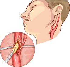 The arteries in neck that supply blood to the brain are called carotid arteries. Carotid Artery Disease Treatment Vascular Institute