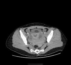 How do you know if you have a cyst that needs treatment and when should you see a doctor? Ruptured Ovarian Cyst Radiology Reference Article Radiopaedia Org