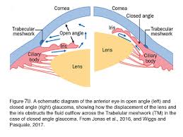 Any of a group of eye diseases characterized by abnormally high intraocular fluid pressure, damaged optic disk, hardening of the eyeball. What Is Glaucoma By David Krizaj Webvision